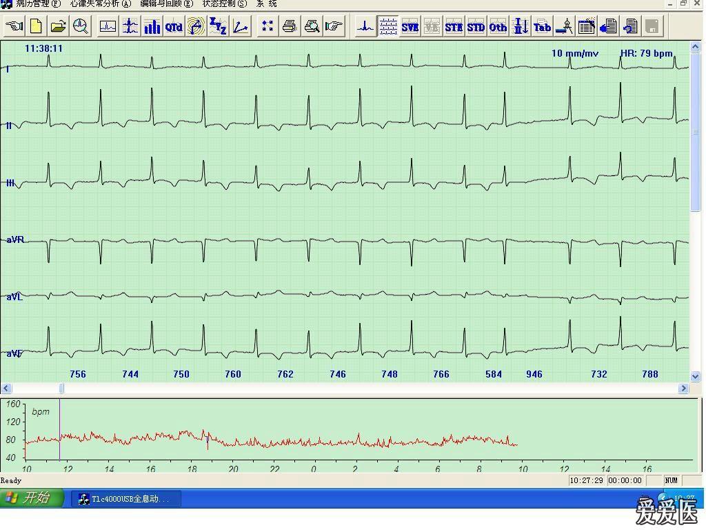 动态心电图报告结论 1202221045b1444516ac8cc25e.jpg