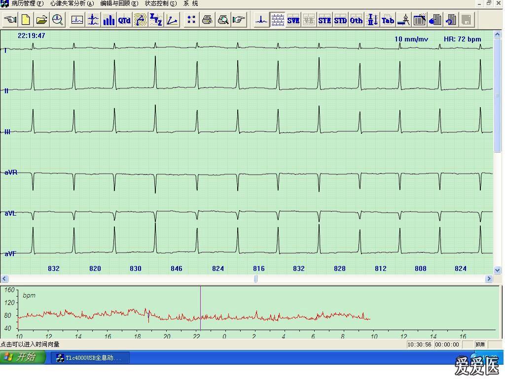 动态心电图报告结论 120222104742de141e8aace375.jpg