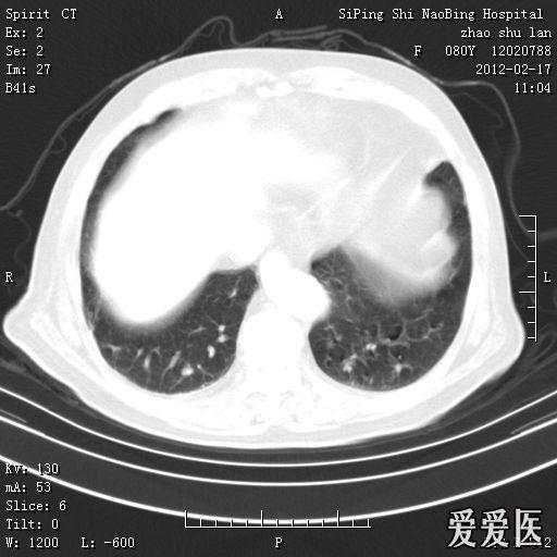 头部核磁忘了脱内衣_头部核磁