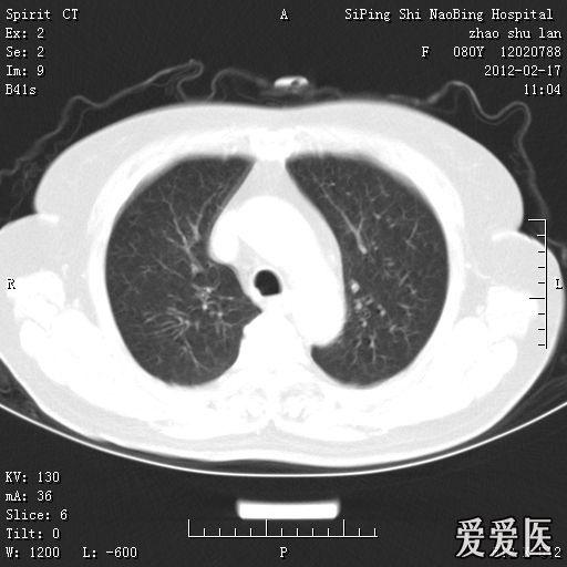 头部核磁忘了脱内衣_头部核磁