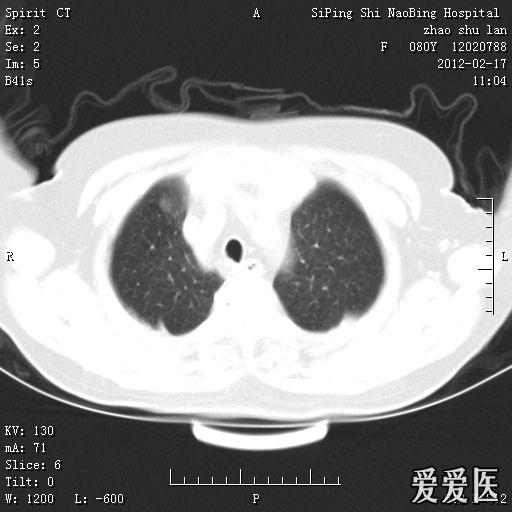 头部核磁忘了脱内衣_头部核磁