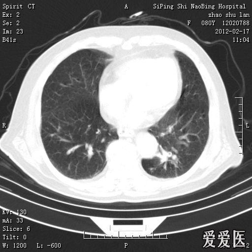 头部核磁忘了脱内衣_头部核磁