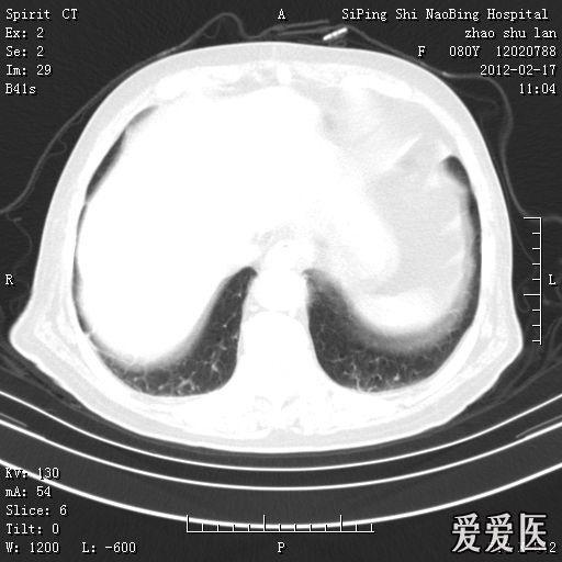 头部核磁忘了脱内衣_头部核磁