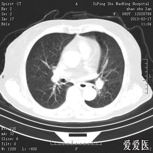 头部核磁忘了脱内衣_头部核磁