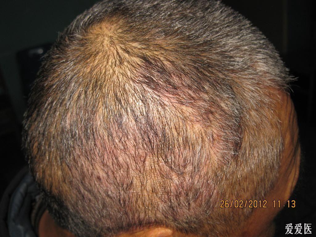 典型病例银屑病束状发
