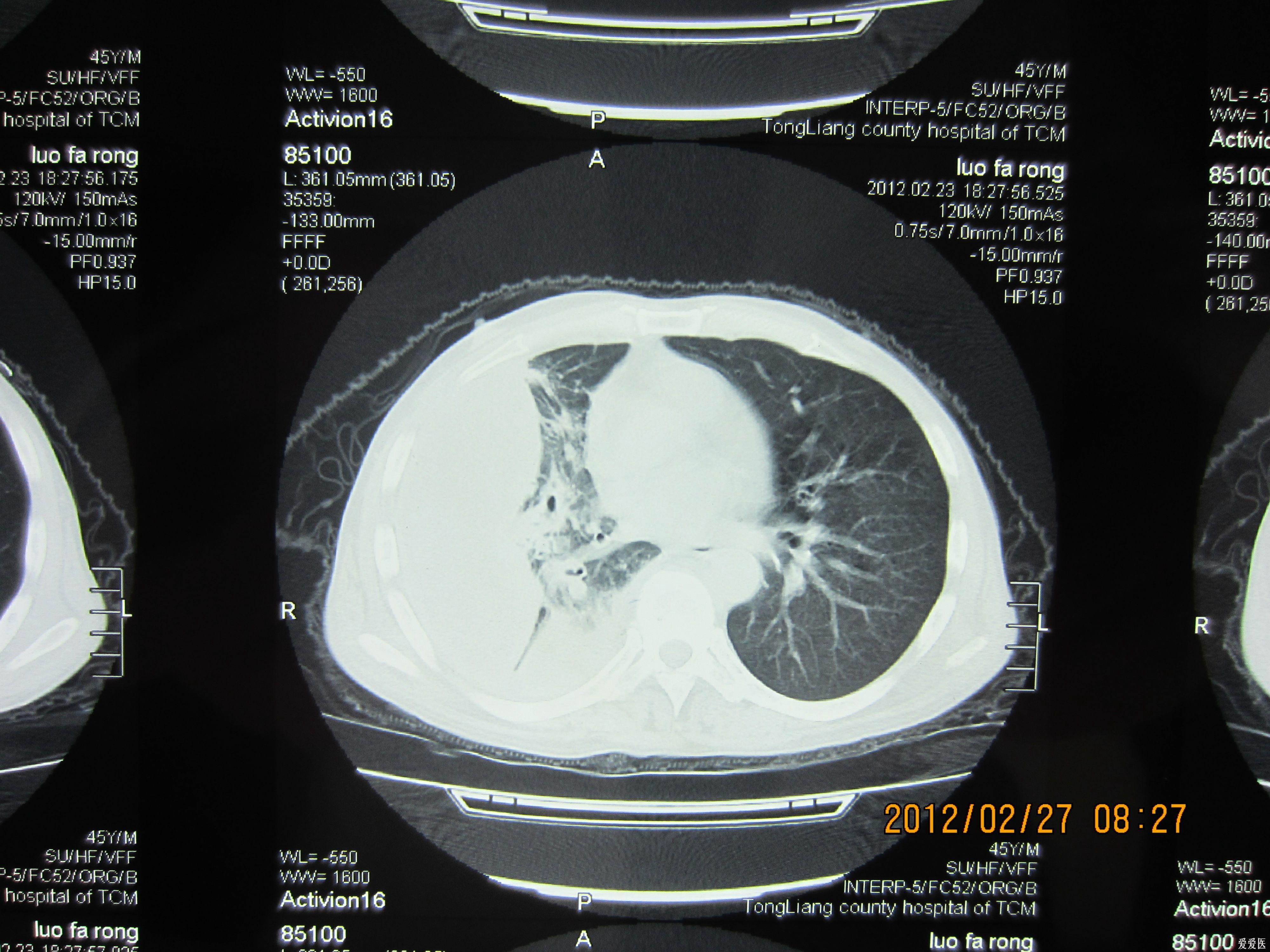 结核性胸膜炎ct表现图片