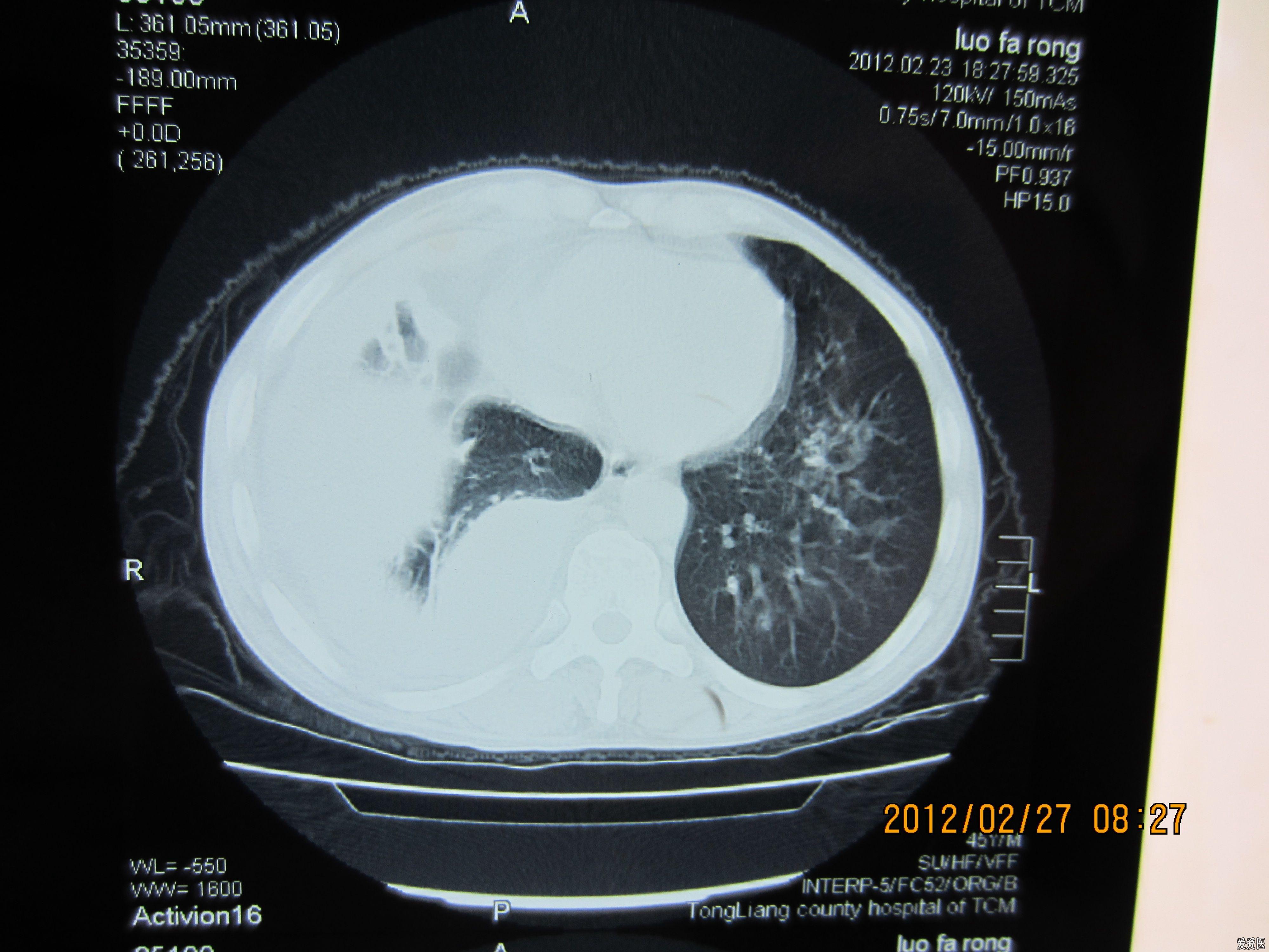 结核性渗出性胸膜炎图片