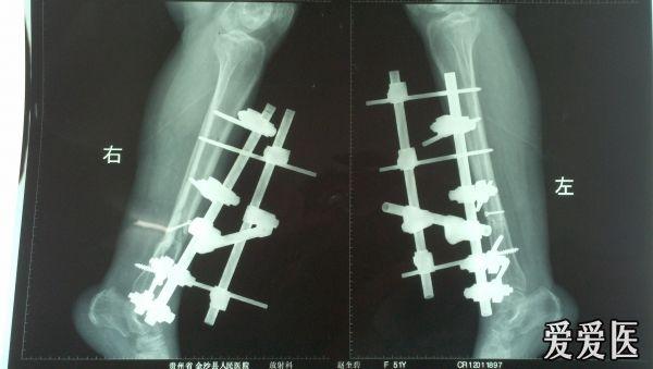 胫腓骨骨折外固定术后 骨科与显微外科专业讨论版 爱爱医医学论坛