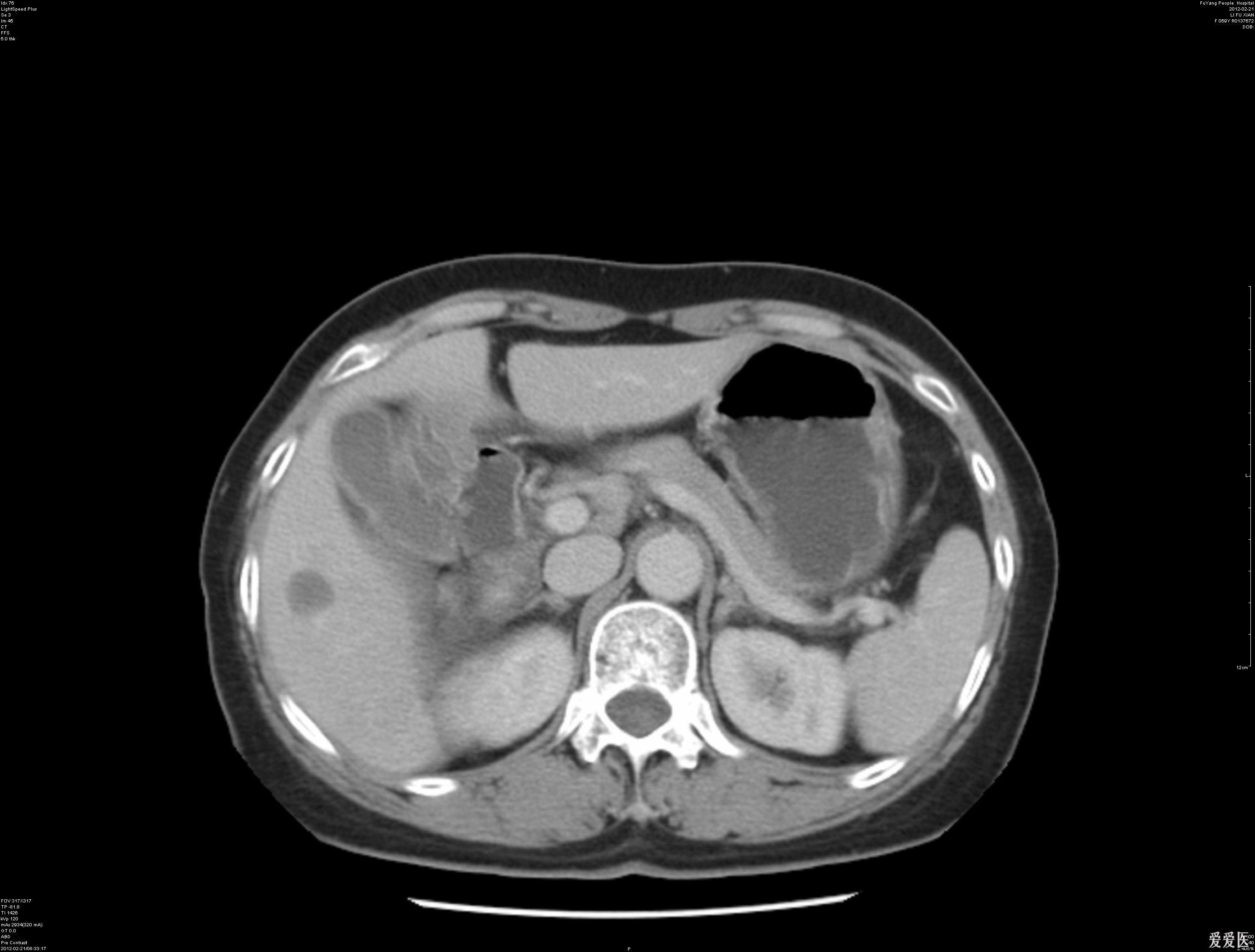 肝内占位影像检查