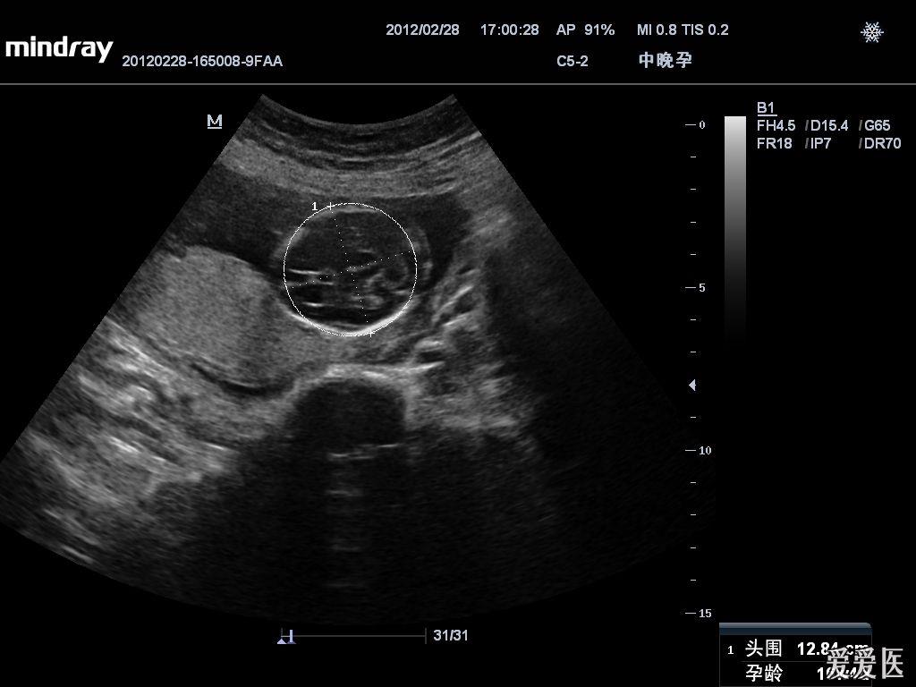 胎儿腹裂图片