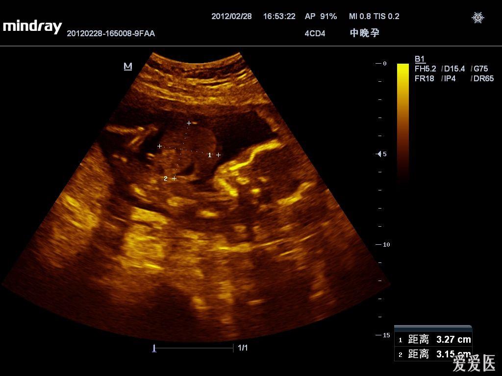 胎儿腹裂 - 超声医学讨论版 - 爱爱医医学论坛