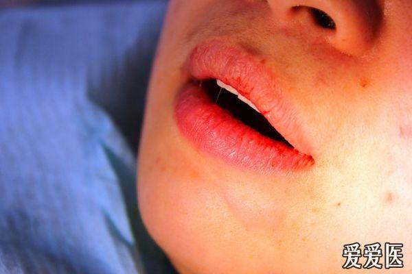 术后下唇外观