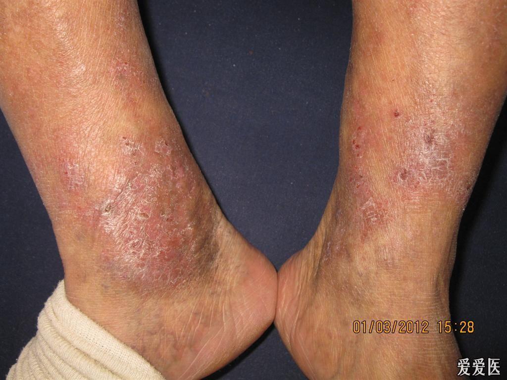 看图识病淤积性皮炎