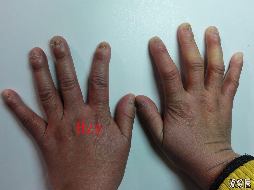 看图诊病甲营养不良