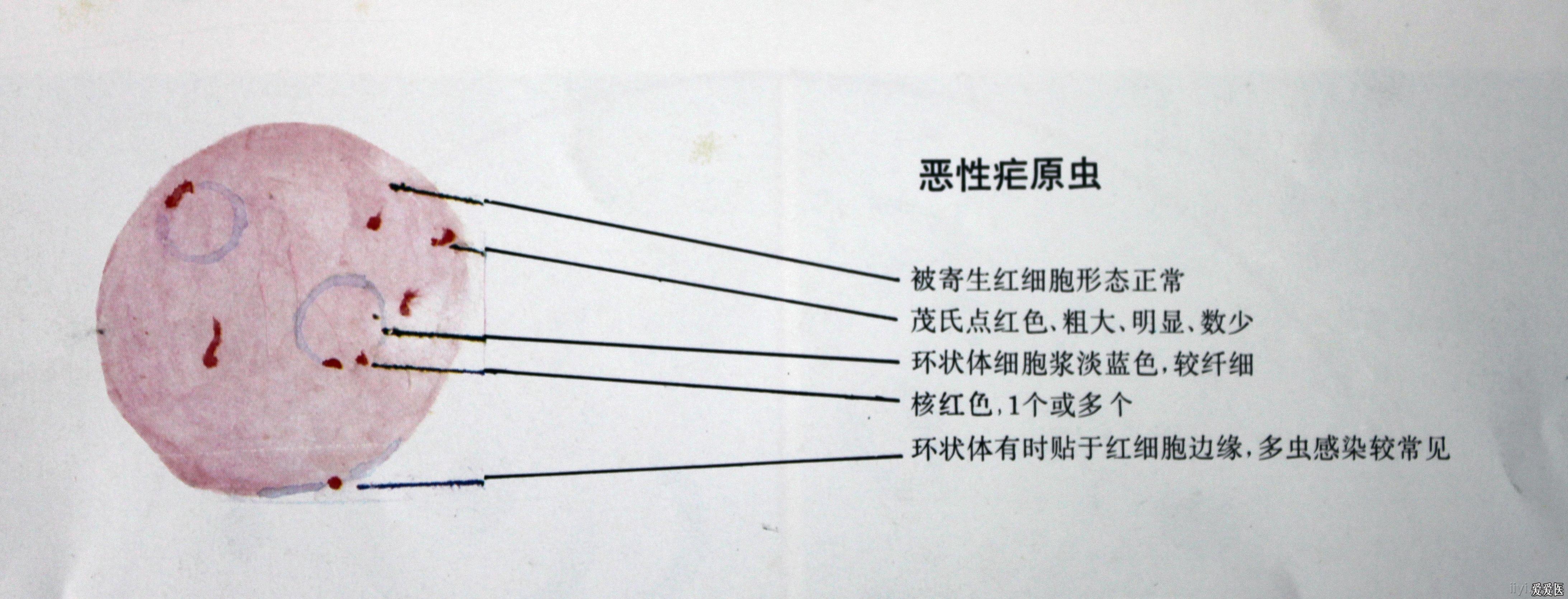 恶性疟原虫配子体结构图片