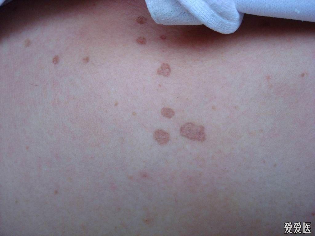 典型皮肤病之汗孔角化症