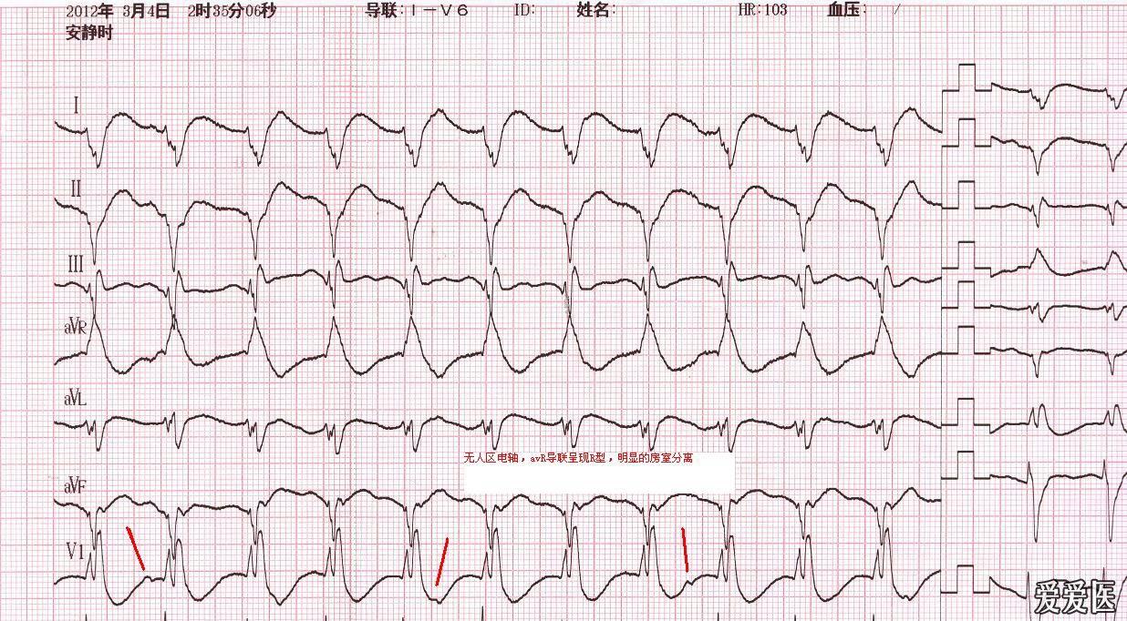 心电图无人区电轴图片