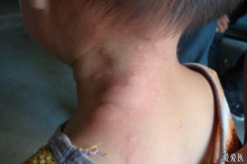 典型皮肤病之荨麻疹