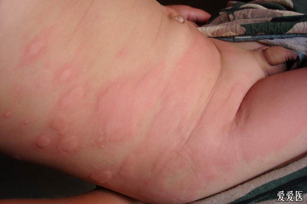 八个月宝宝荨麻疹图片图片