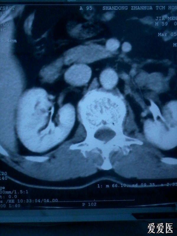 珍贵资料这是先天肥大的肾柱还是肿瘤敬请讨论留言待续