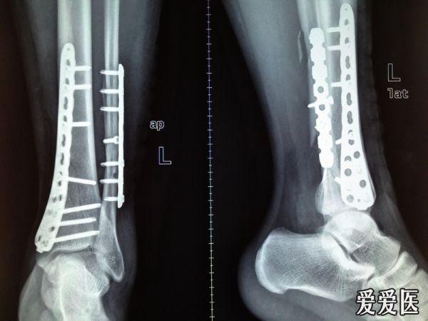 左胫腓骨下端骨折内固定3个月x光片 是否可以完全负重 骨科与显微外科专业讨论版 爱爱医医学论坛