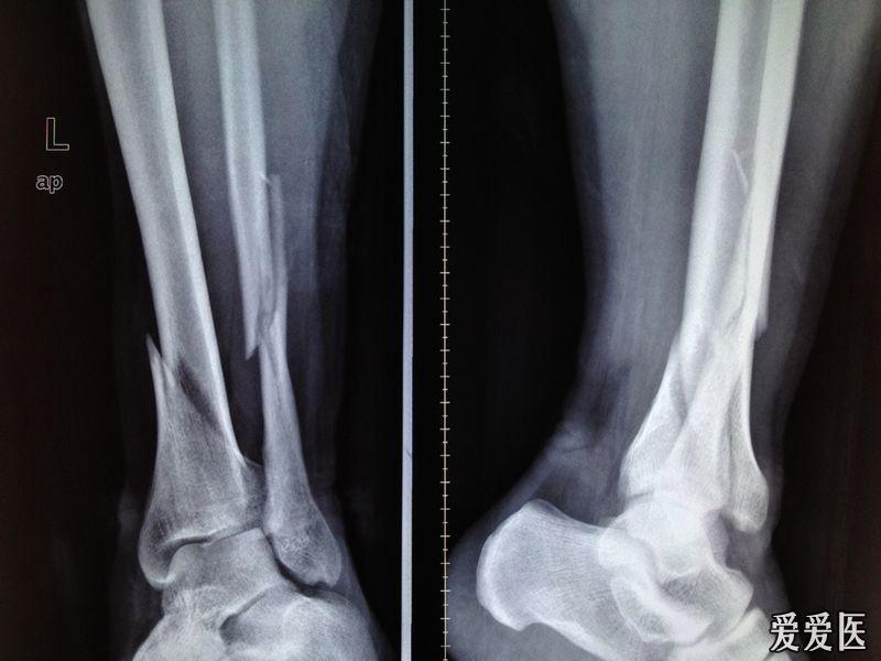 左脚腓骨骨折照片图片