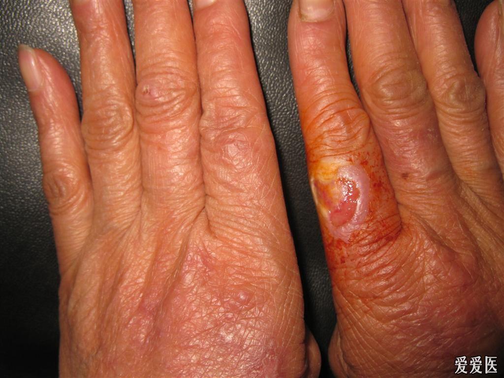 看图识病丹毒
