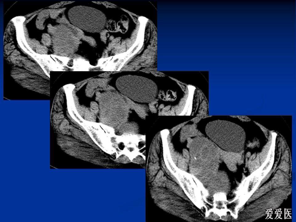 轉盆腔病變ct
