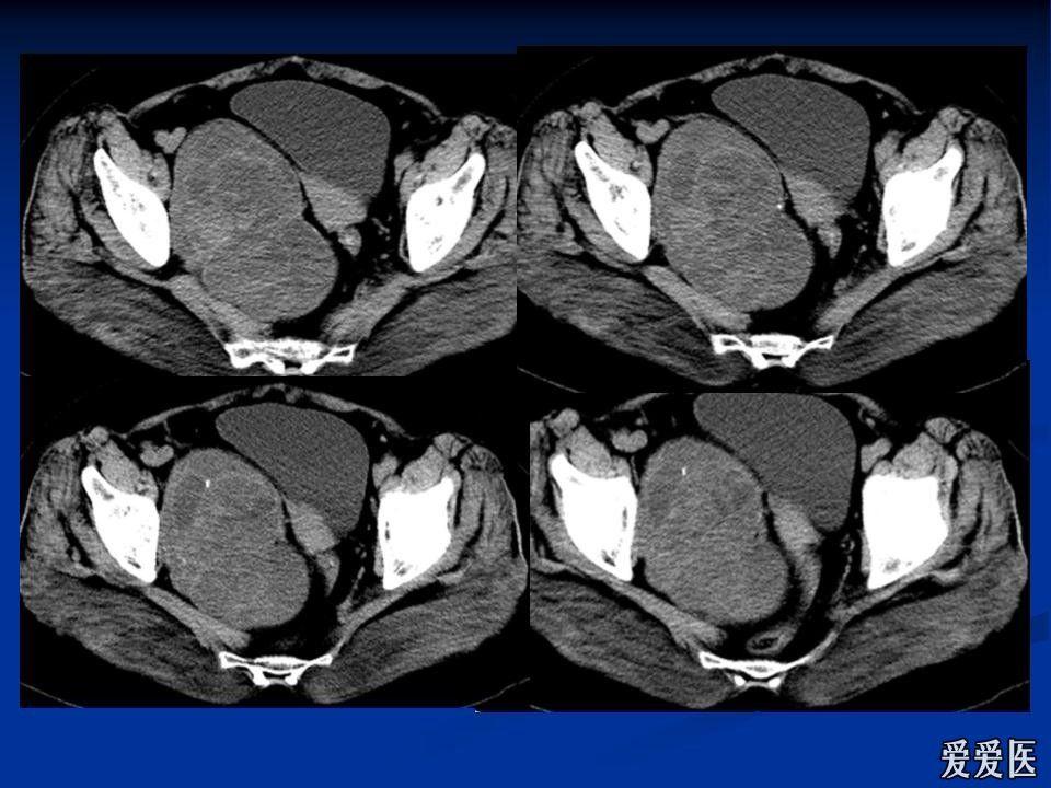 轉盆腔病變ct