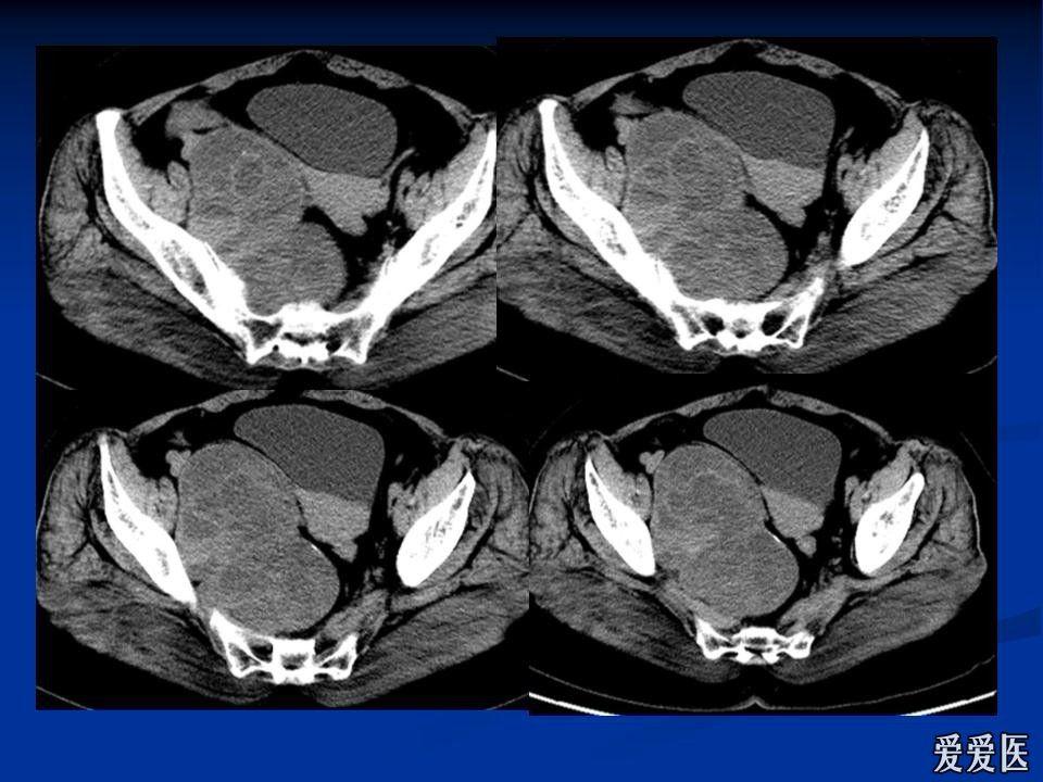 转--盆腔病变ct - 医学影像学讨论版 - 爱爱医医学论坛