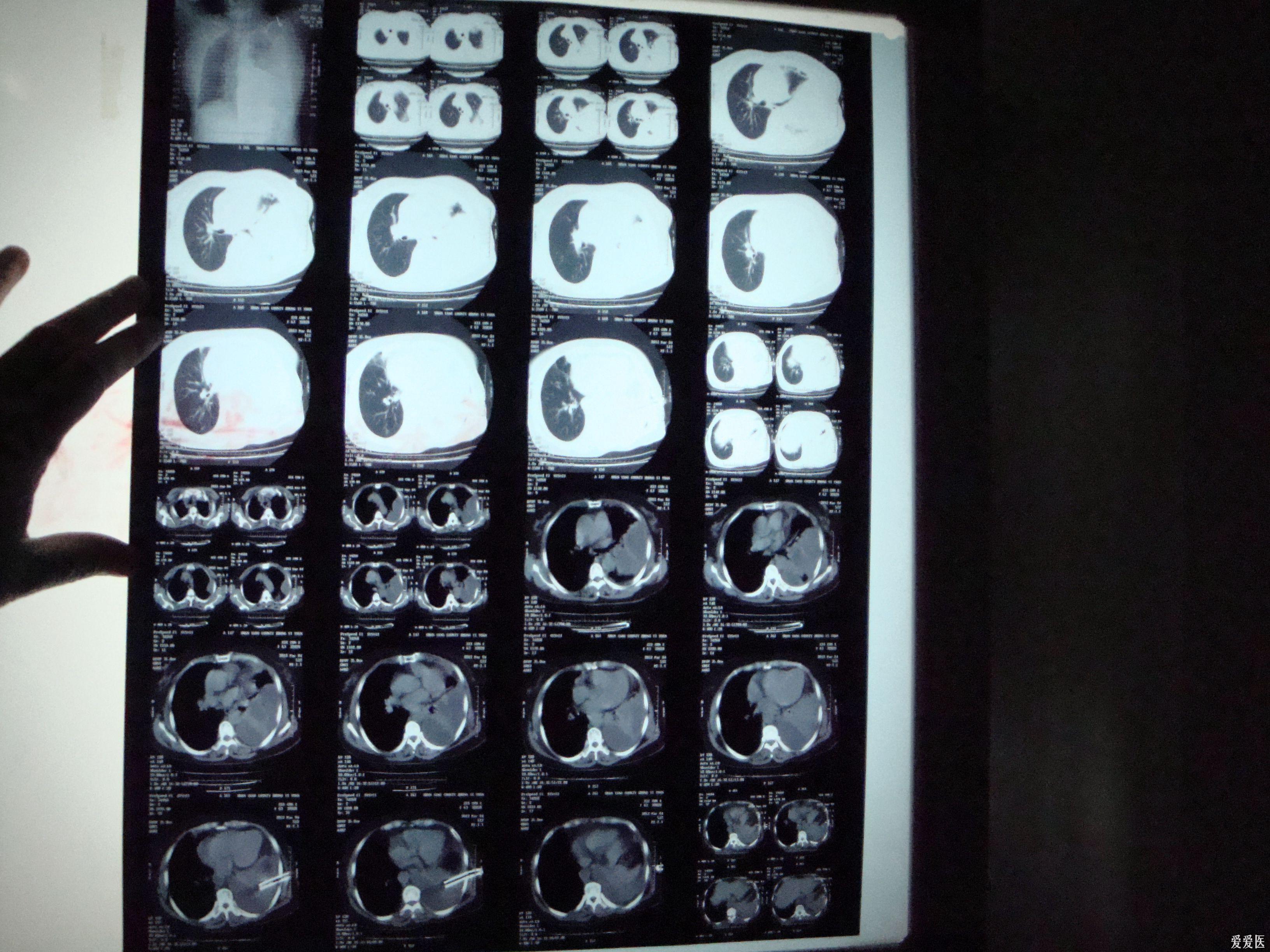 一例胸腔包裹性积液的处理