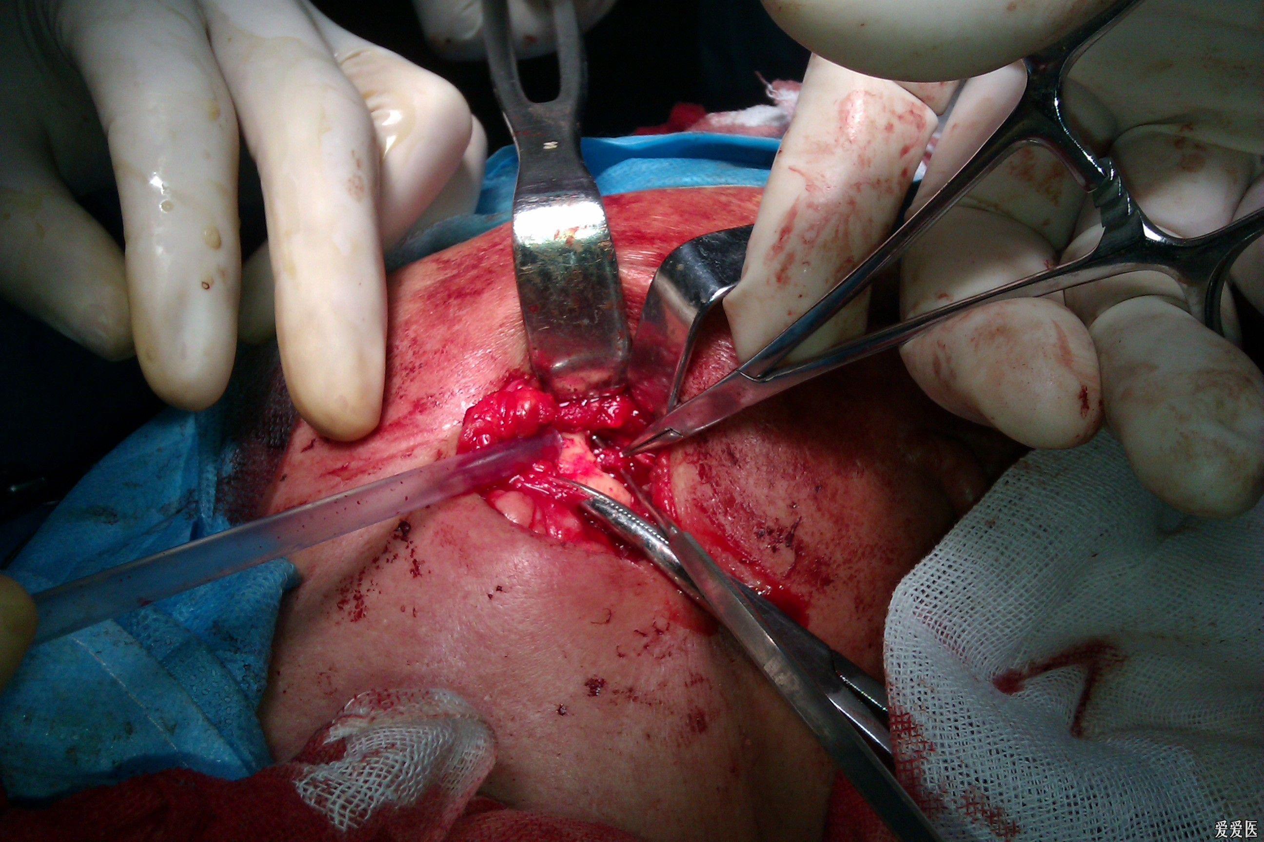 口外法行下牙槽神经切断撕脱术体会