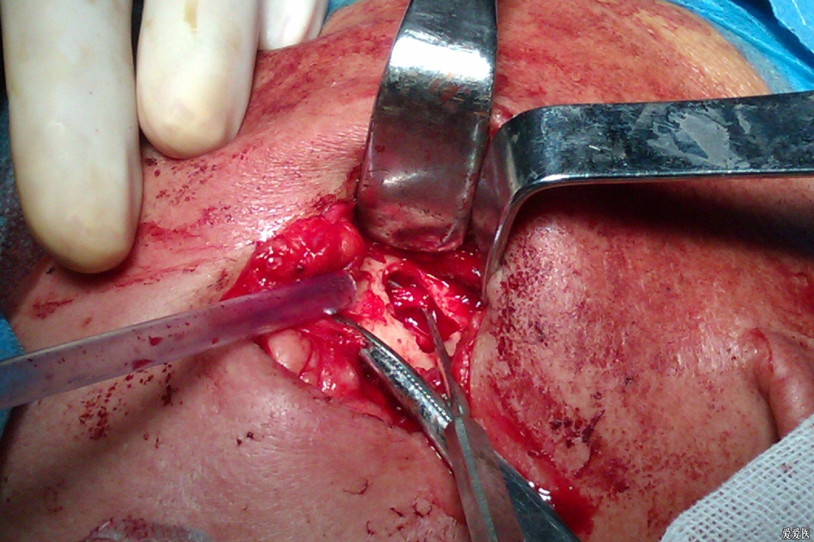 口外法行下牙槽神经切断撕脱术体会