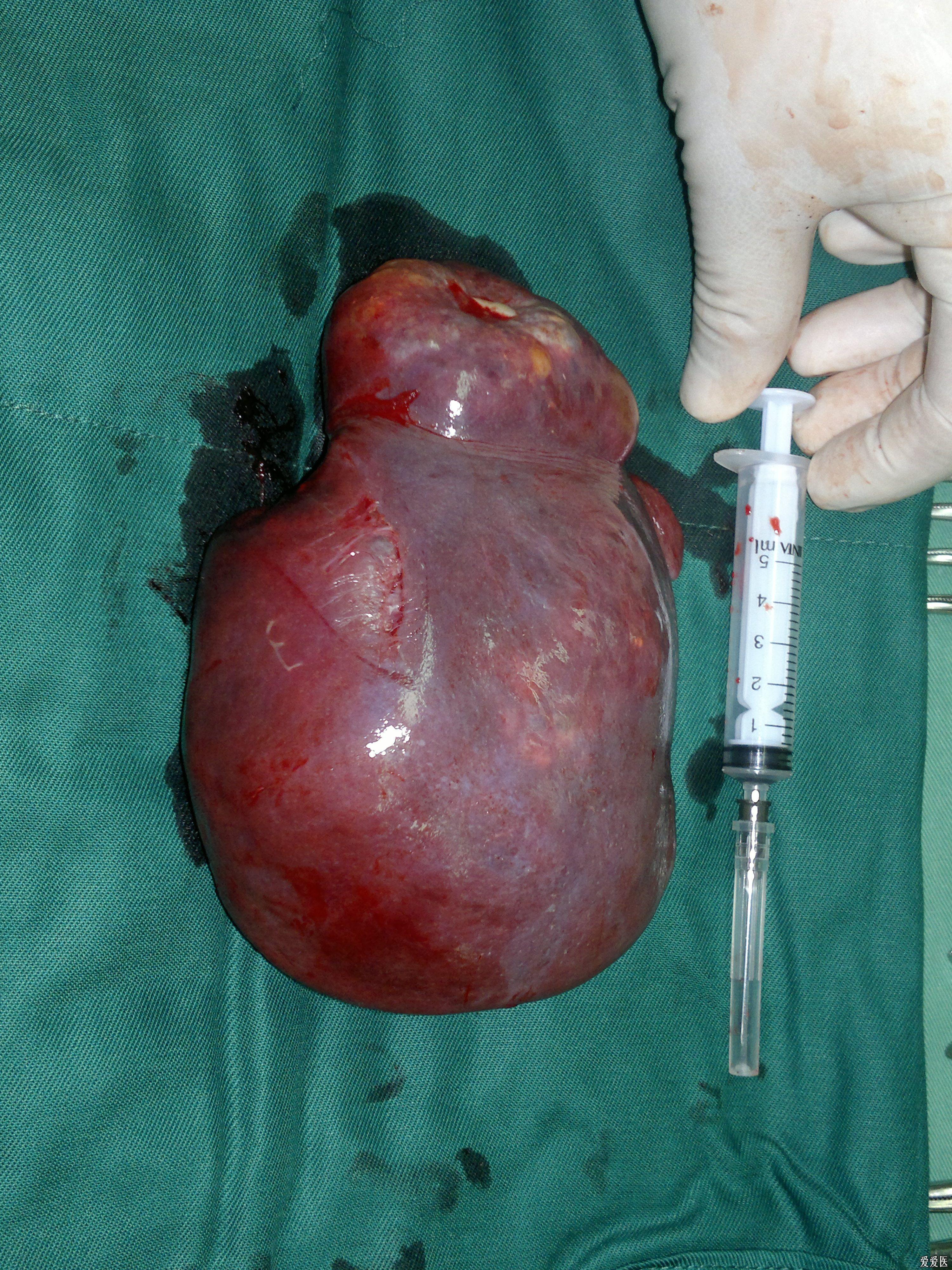 最新病例-我做的的脾切除手术资料