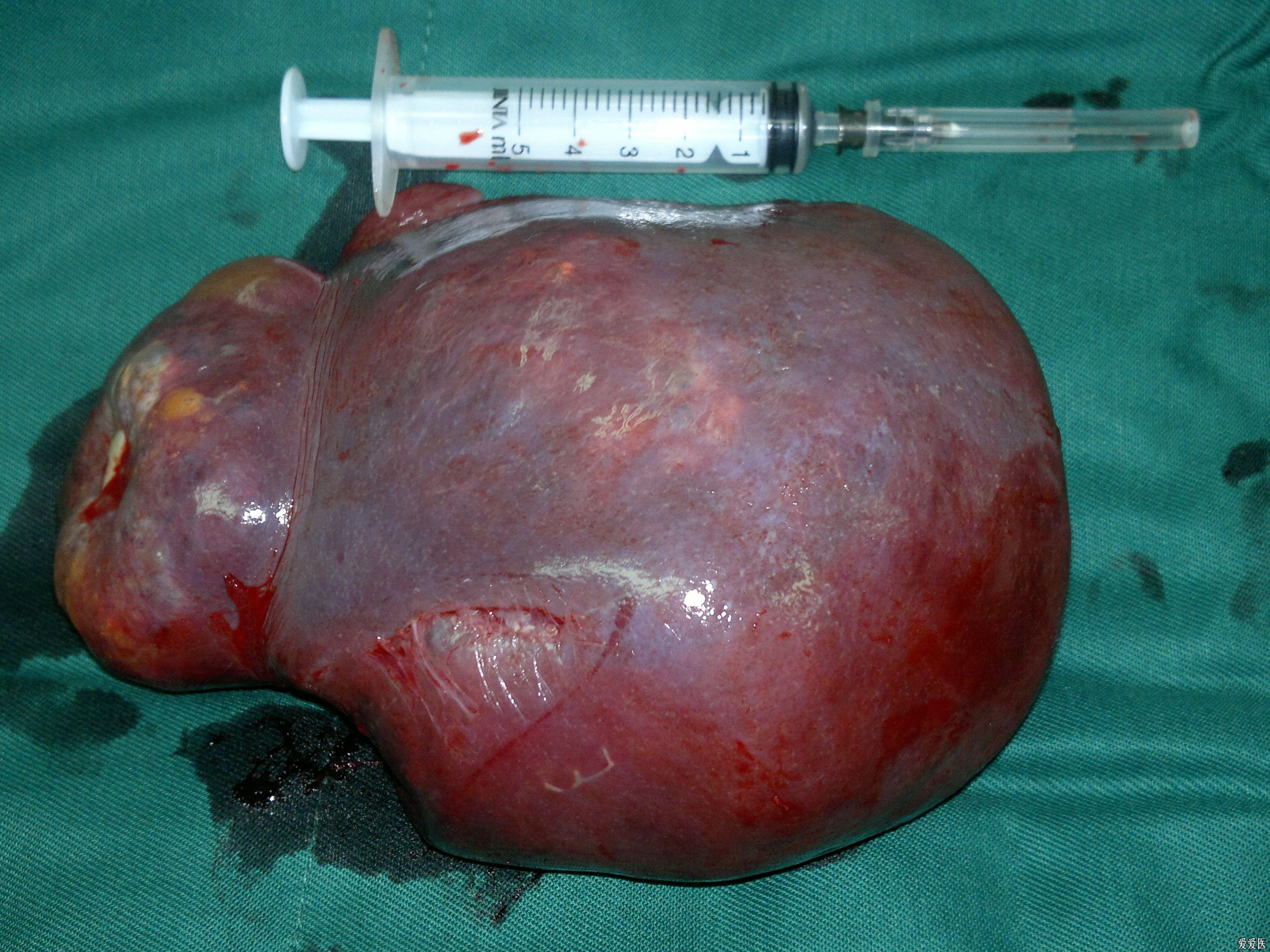 最新病例我做的脾切除手术资料