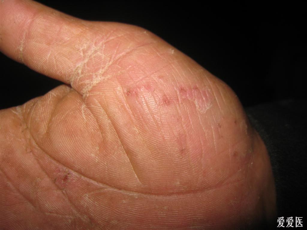 皮肤病手癣