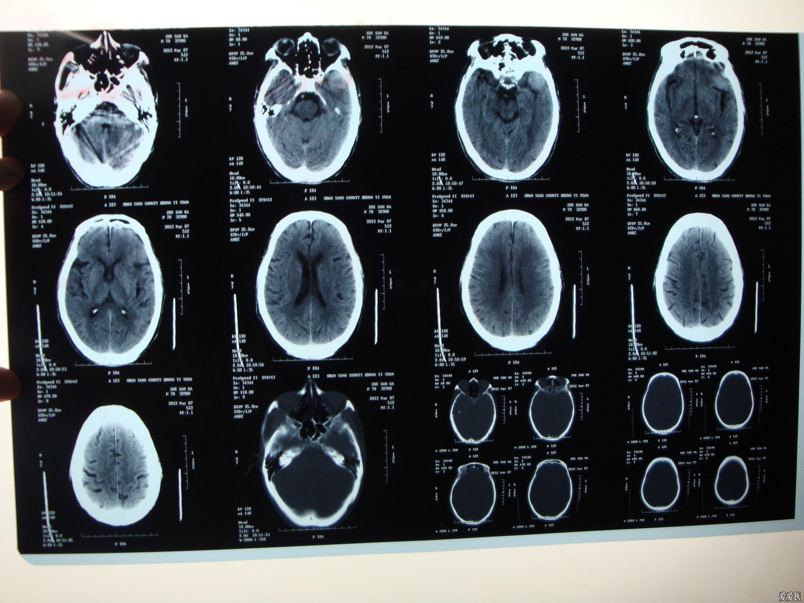 左侧蝶骨嵴外1/3脑膜瘤