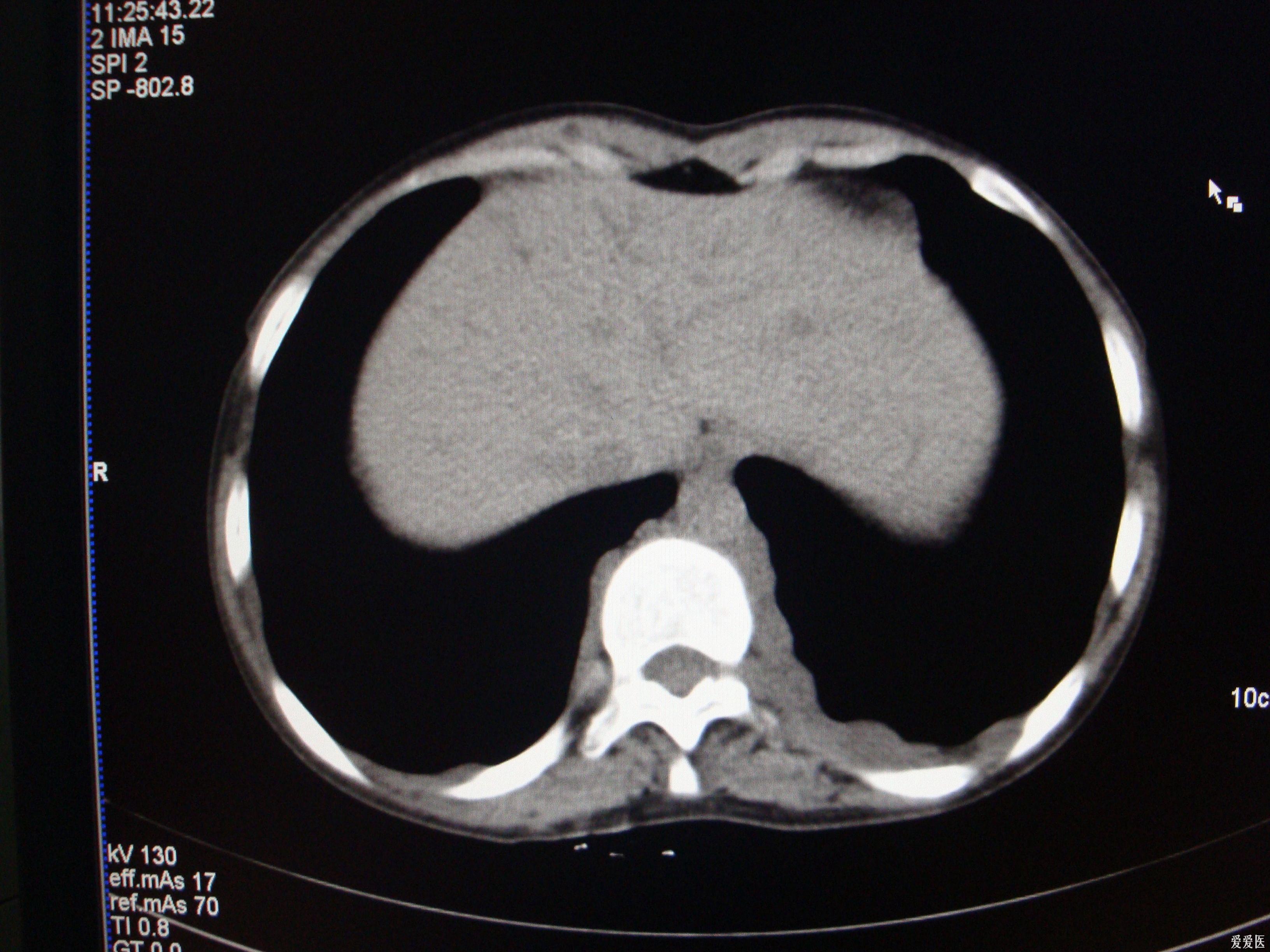 患者女20岁腰痛胸闷就诊部分ct片