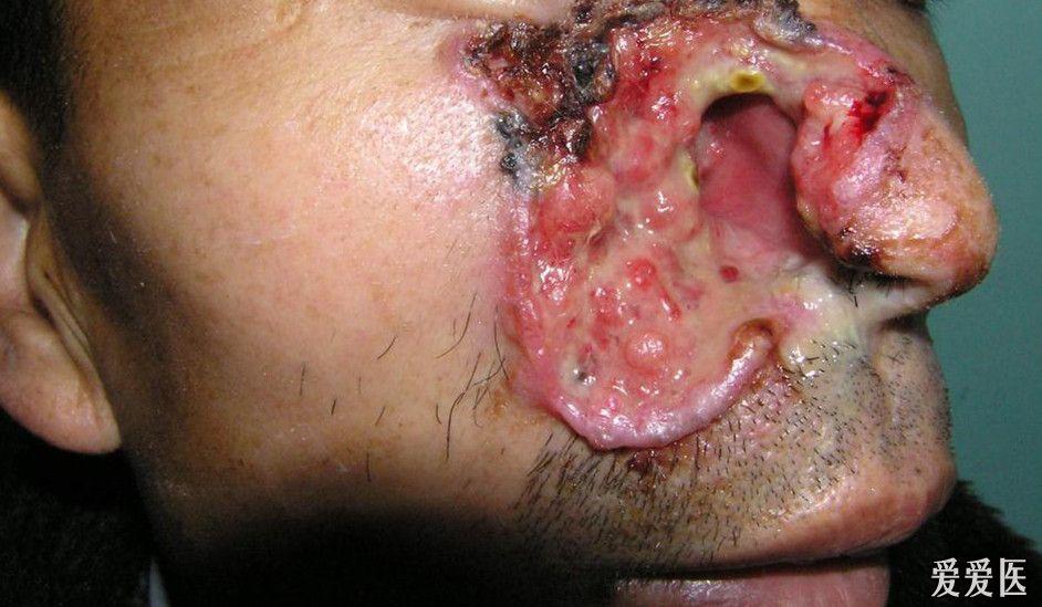 口腔癌脸烂图片 早期图片