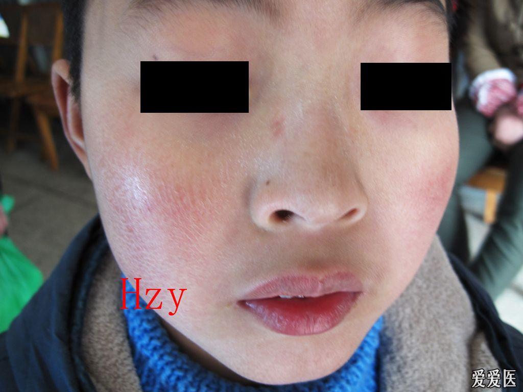 看图诊病异位性皮炎