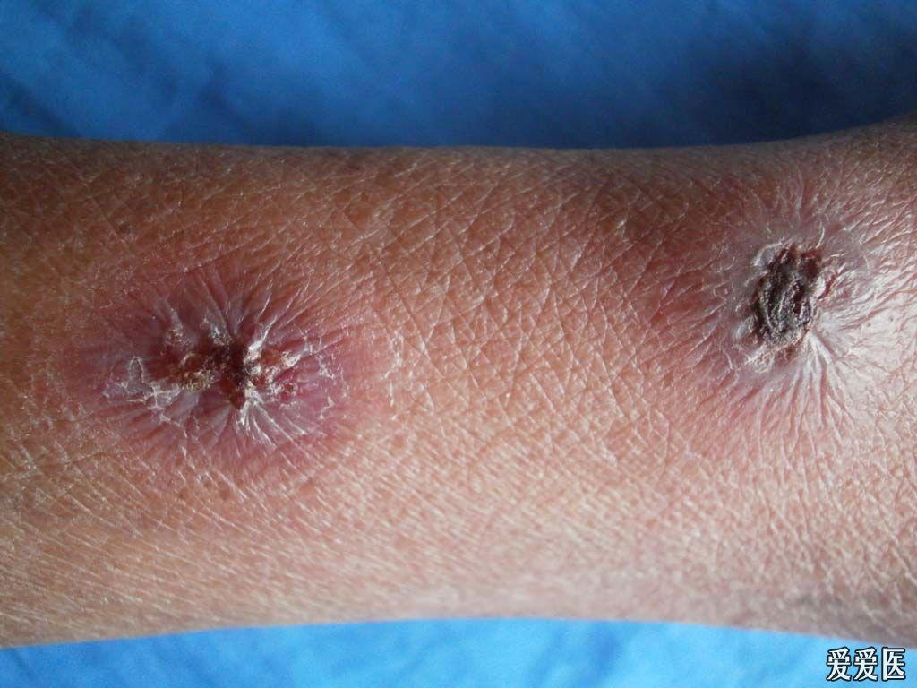 皮肤及性传播疾病讨论版 - 爱爱医医学论坛