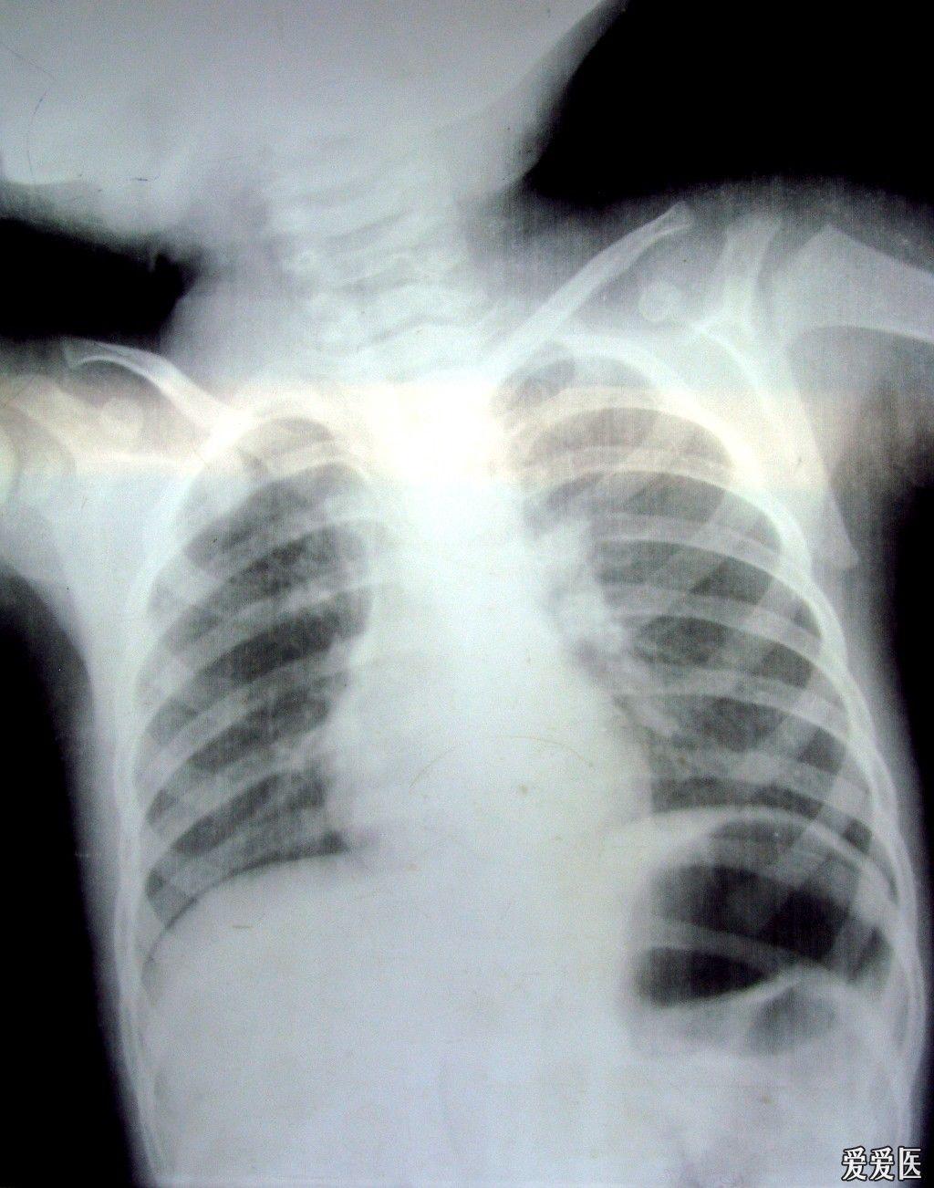 儿童胸片双肺纹理增粗图片