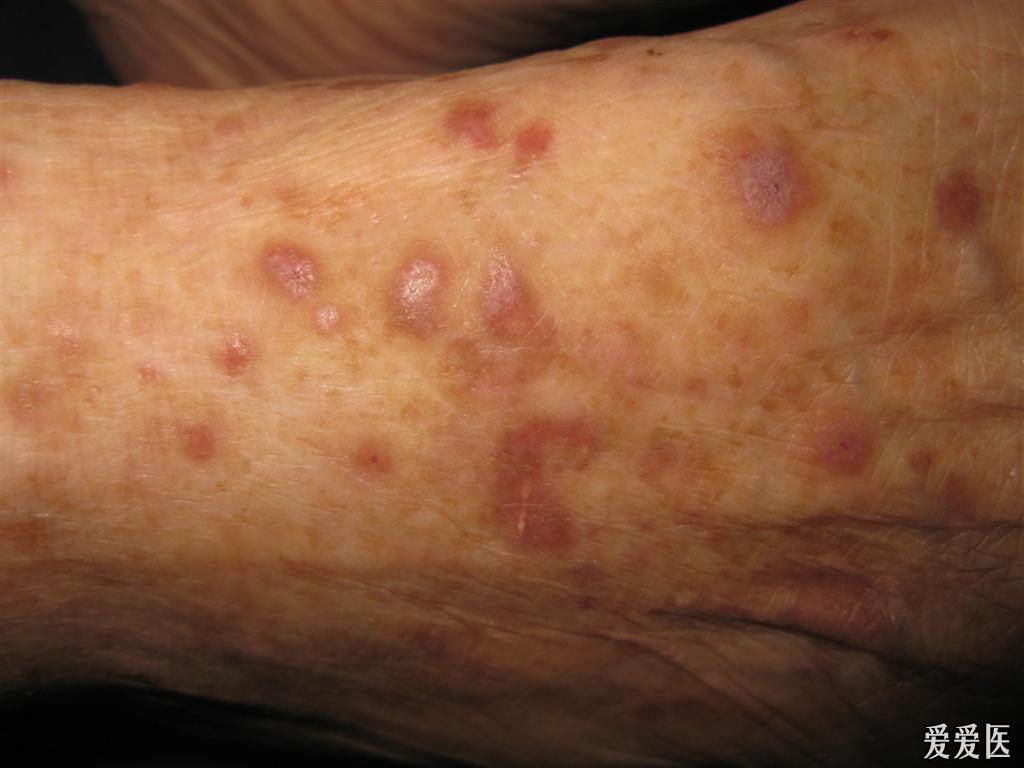 扁平苔癣及wickham纹