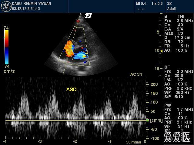 二尖瓣前后叶超声图片