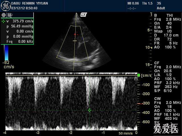 二尖瓣脱垂超声图像图片
