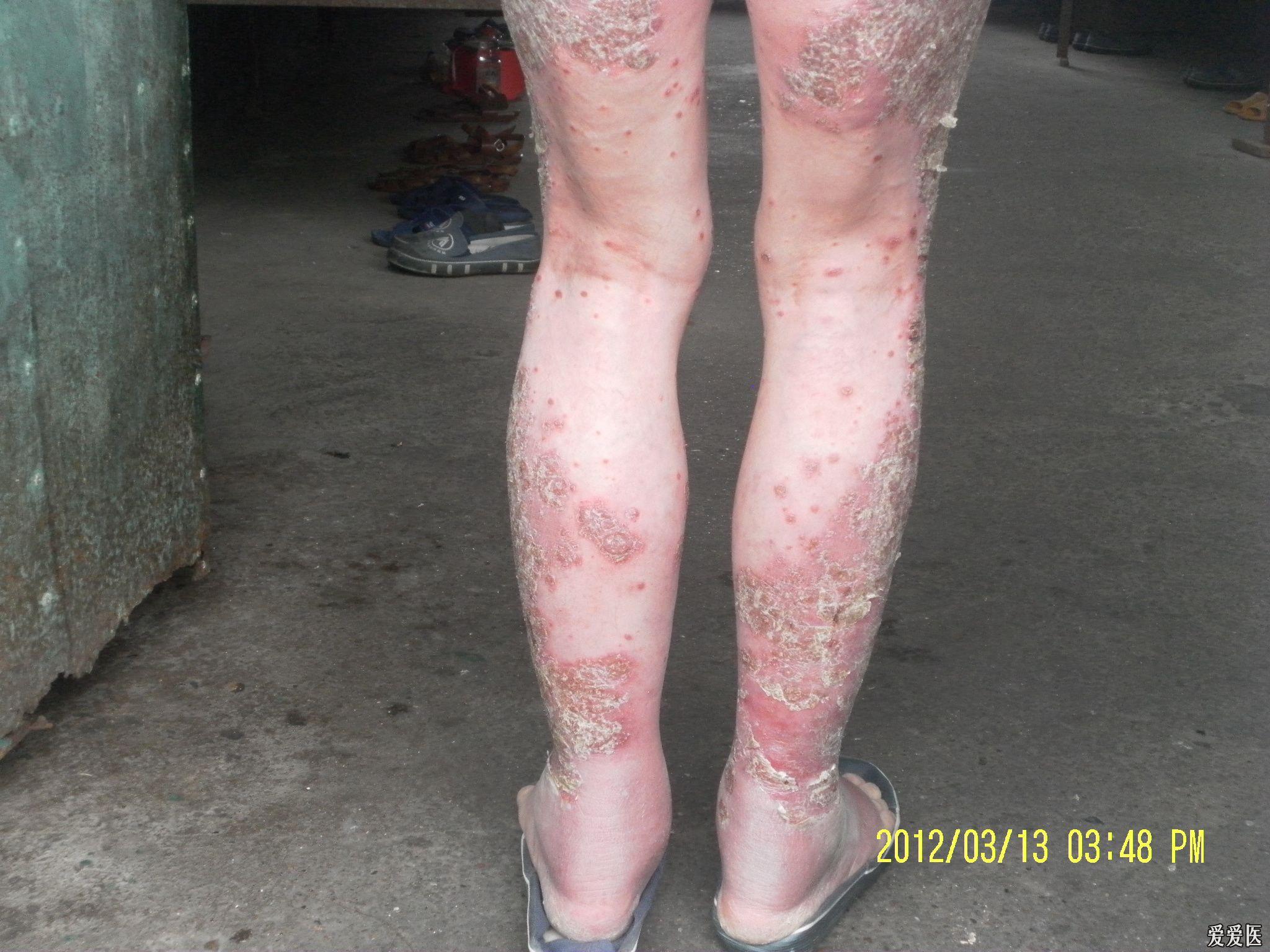 彩图皮肤疑难病例是否银屑病