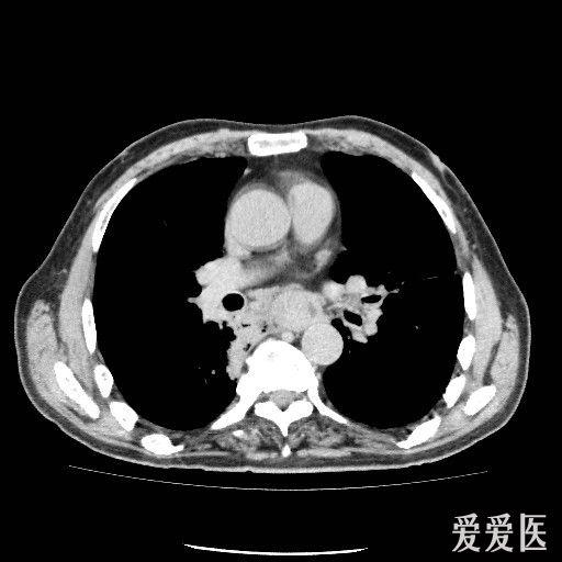 讀片胸部ct