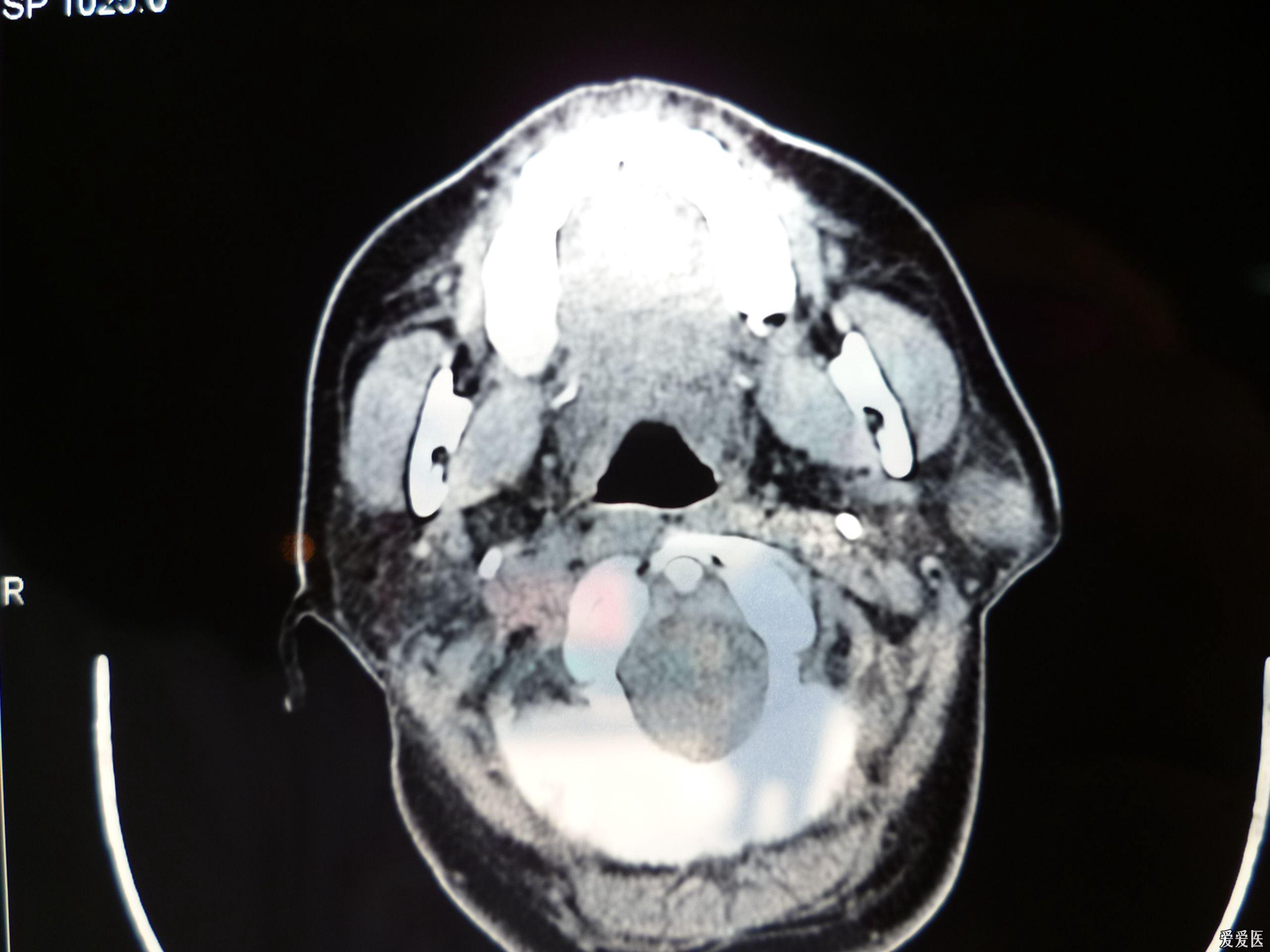 腮腺导管结石ct图片图片