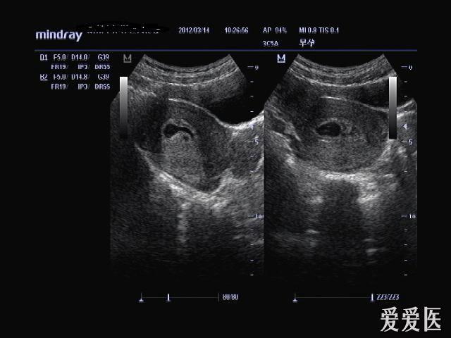 宫腔粘连带? - 超声医学讨论版 - 爱爱医医学论坛