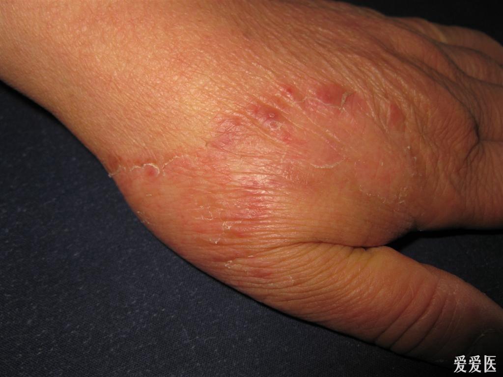 病例分享手癣